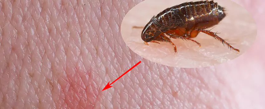 Flea Control for Humans Westminster, CA